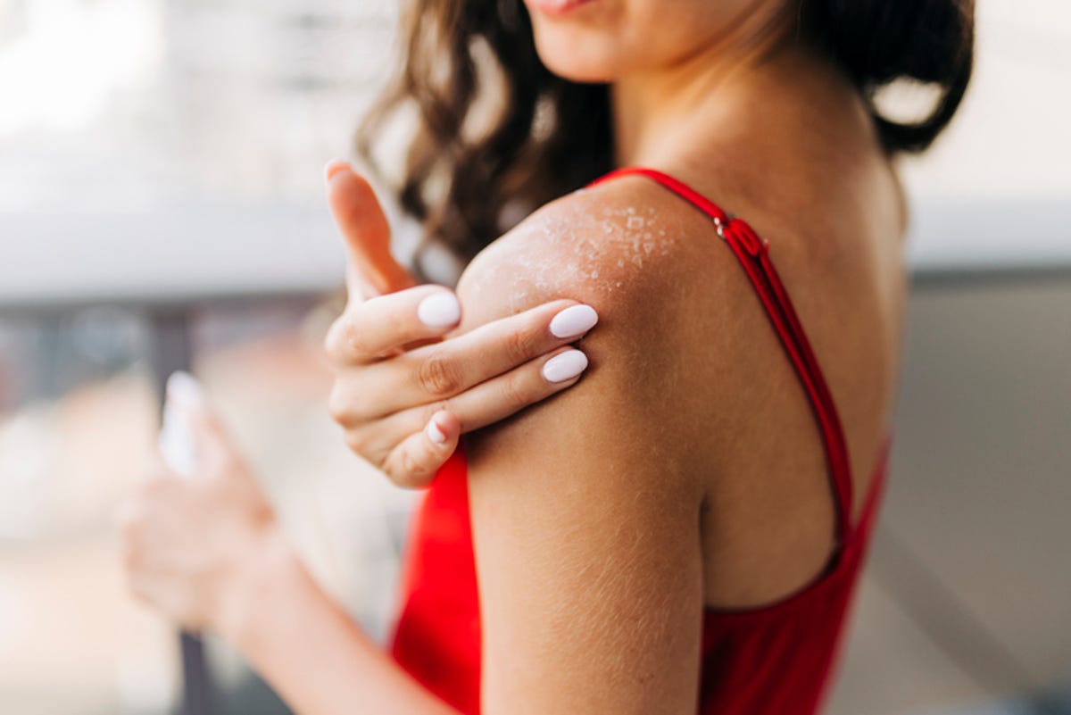 Woman touching a dry patch of skin on her shoulder.